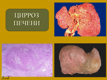 Патоморфология исходов хронических вирусных гепатитов (цирроз печени, первичный рак печени)