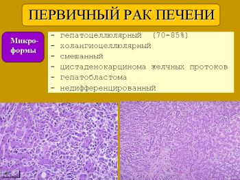 Патоморфология исходов хронических вирусных гепатитов (цирроз печени, первичный рак печени)