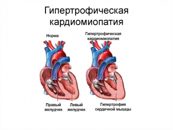 Насколько опасна гипертрофическая кардиомиопатия?