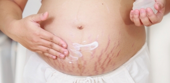 Растяжки на коже у беременных