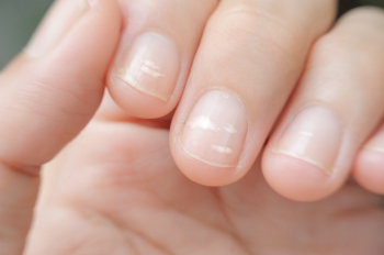 Белые пятнышки на ногтях